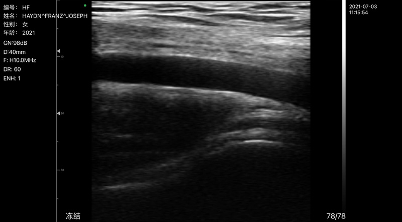 Wireless Ultrasound for Artère axillaire C