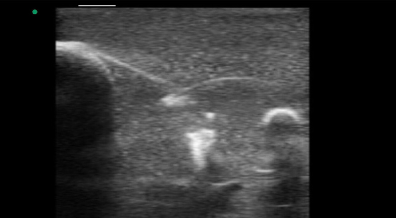 Wireless Ultrasound for Formation de biopsie du sein