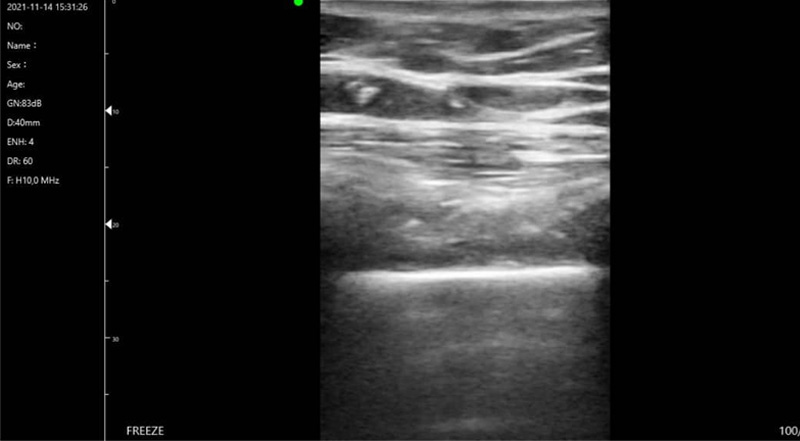 Wireless Ultrasound for Poumon C10T