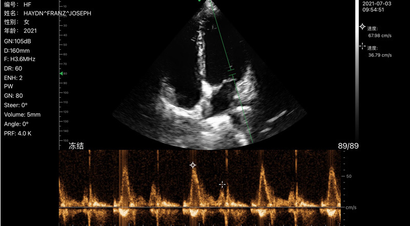 Wireless Ultrasound for PW cardiaque