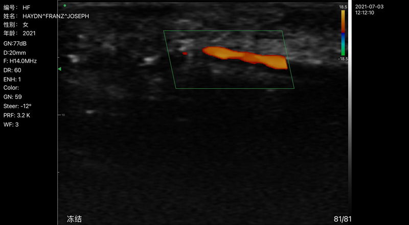 Wireless Ultrasound for Artère de doigt