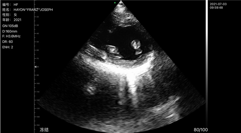 Wireless Ultrasound for Muscle cardiaque papillaire