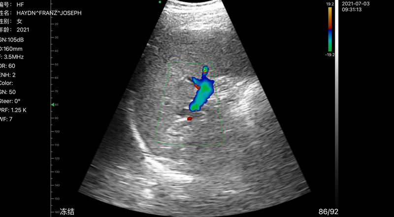 Wireless Ultrasound for Rate