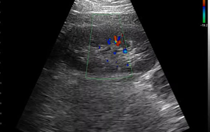 Sonde abdominale Échographie rein C