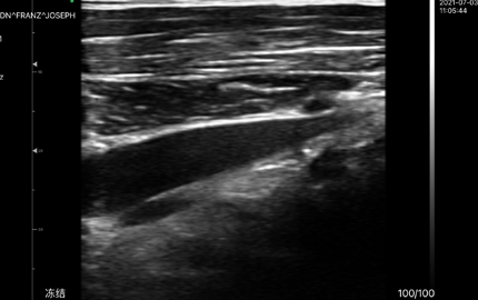 Sonde d'échographie abdominale foie B