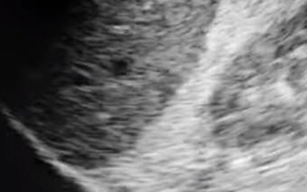 Échographie médicale portable HCM épanchement pleural